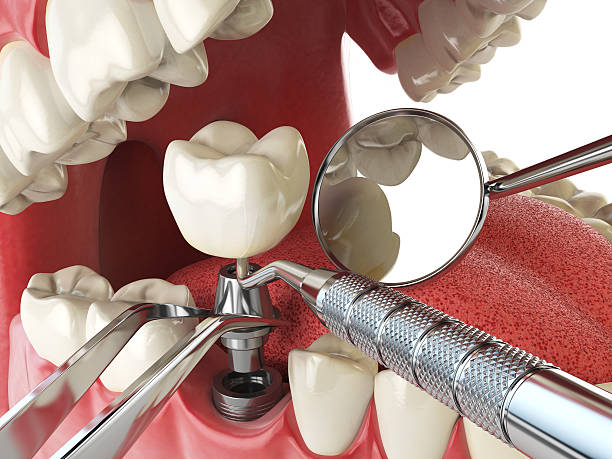Best Knocked-Out Tooth (Avulsed Tooth) Treatment in Sea Bright, NJ